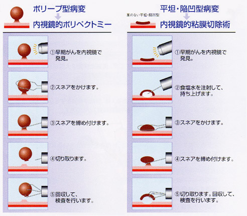 内視鏡でできる治療(手術)