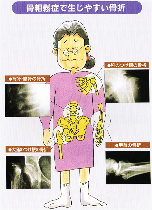骨粗鬆症で生じやすい骨折